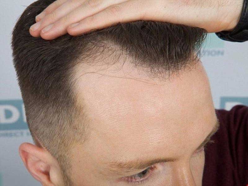 Các cách khắc phục tóc thưa mỏng ở đỉnh đầu